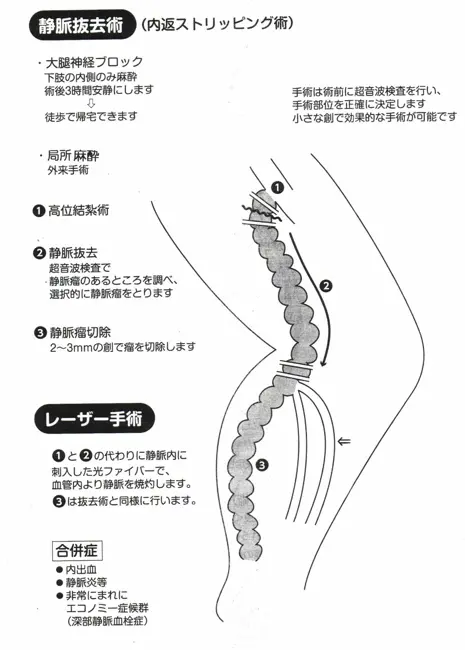 下肢静脈瘤 | 山本クリニック